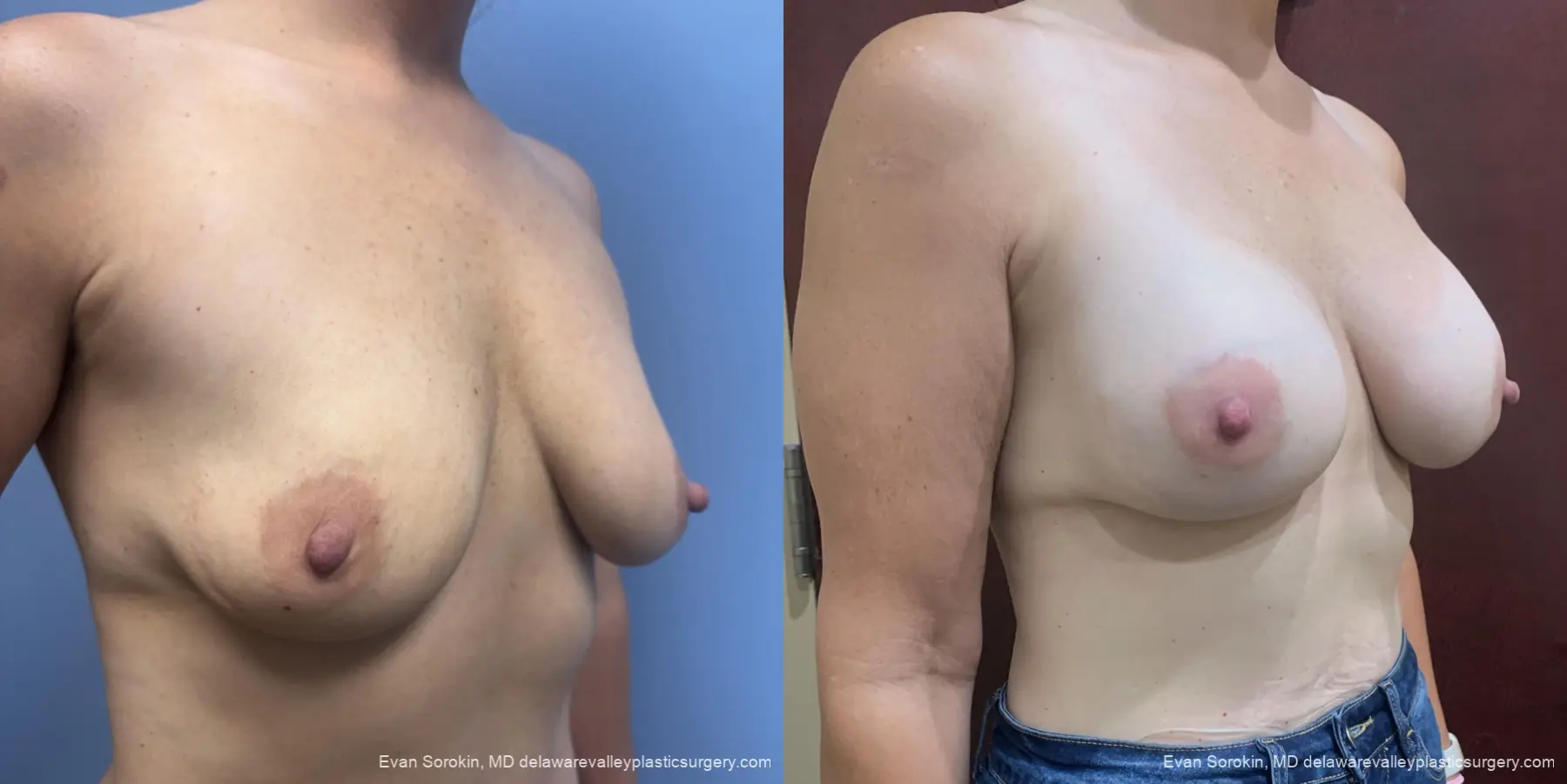 Breast Augmentation: Patient 301 - Before and After 2