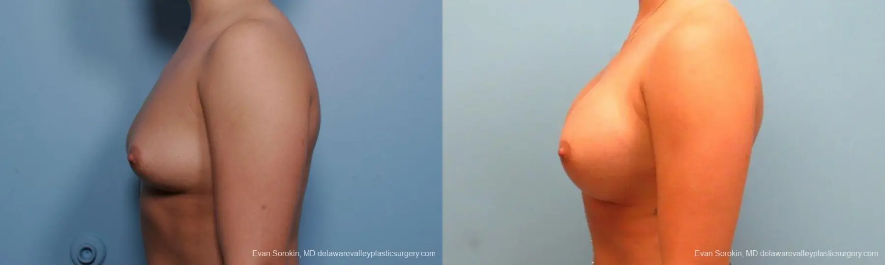 Philadelphia Breast Augmentation 9383 - Before and After 5