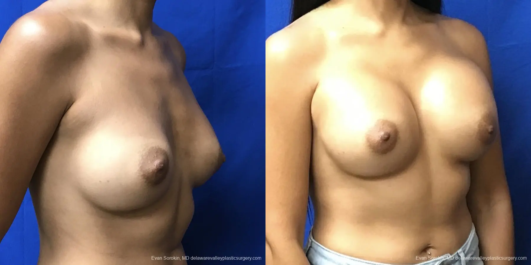 Breast Augmentation: Patient 201 - Before and After 2