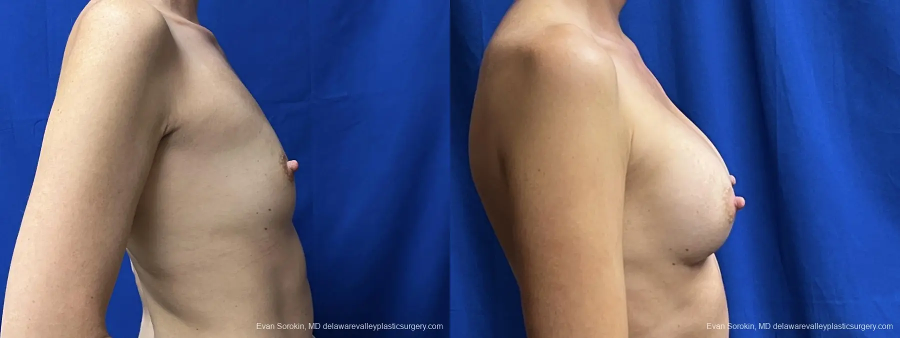 Breast Augmentation: Patient 242 - Before and After 3