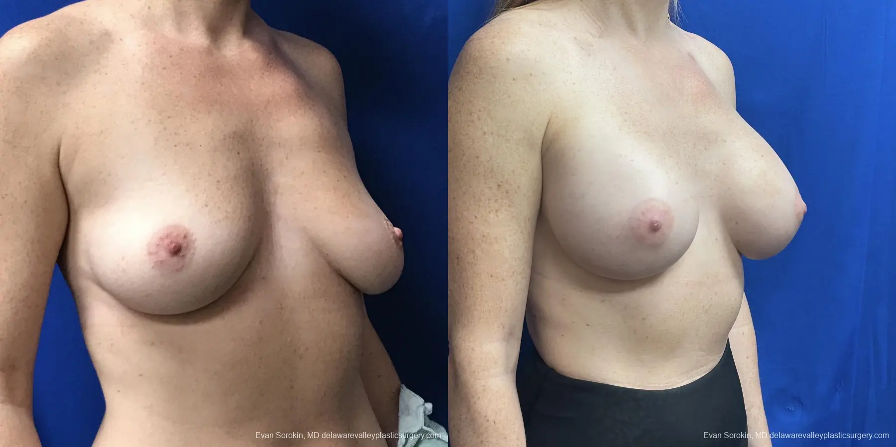 Breast Augmentation: Patient 235 - Before and After 2