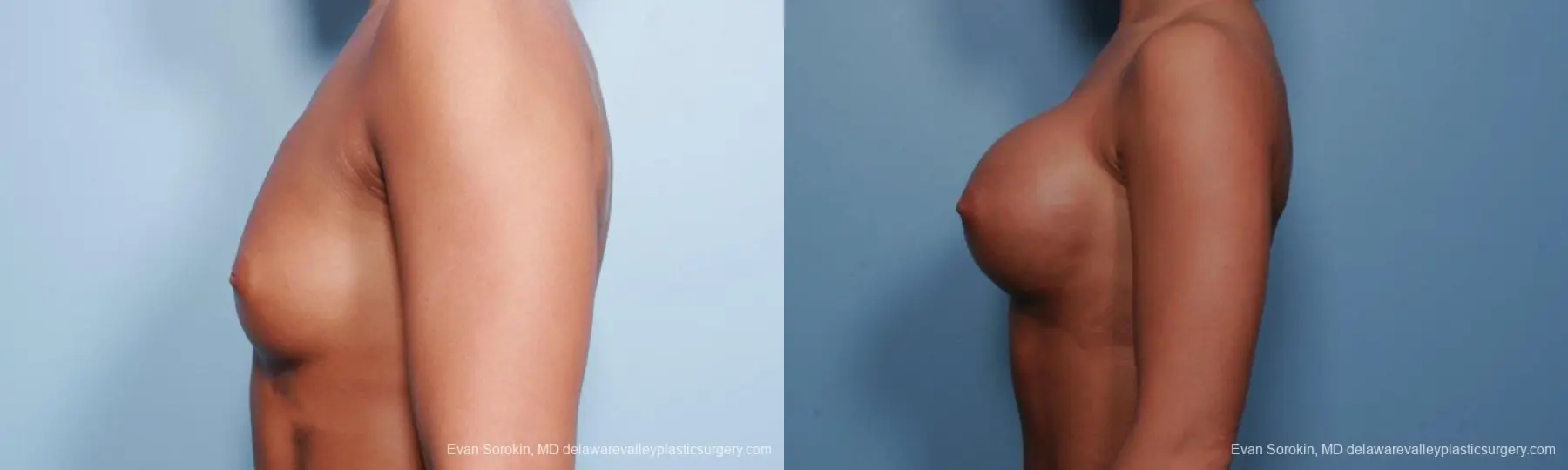 Philadelphia Breast Augmentation 9299 - Before and After 3