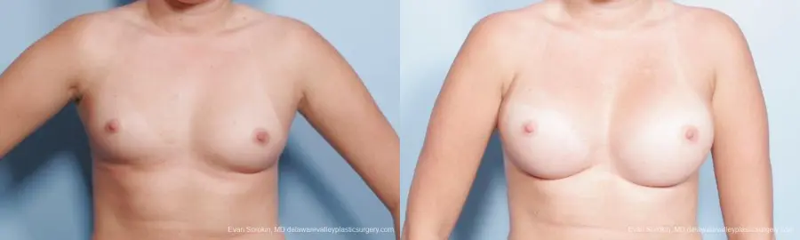 Philadelphia Breast Augmentation 9301 - Before and After 1
