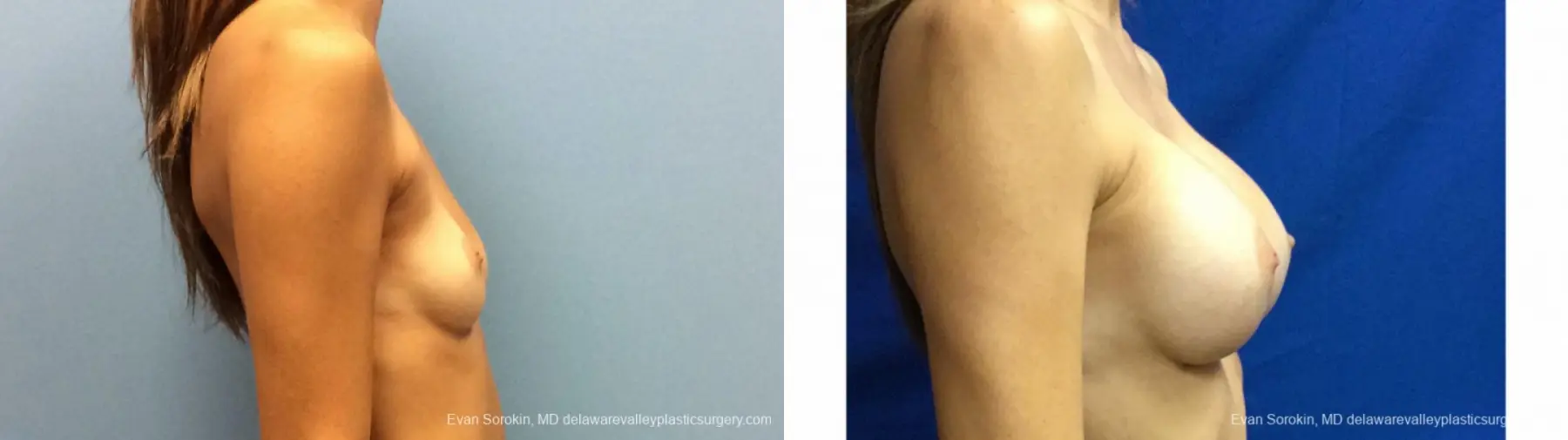 Philadelphia Breast Augmentation 13180 - Before and After 3