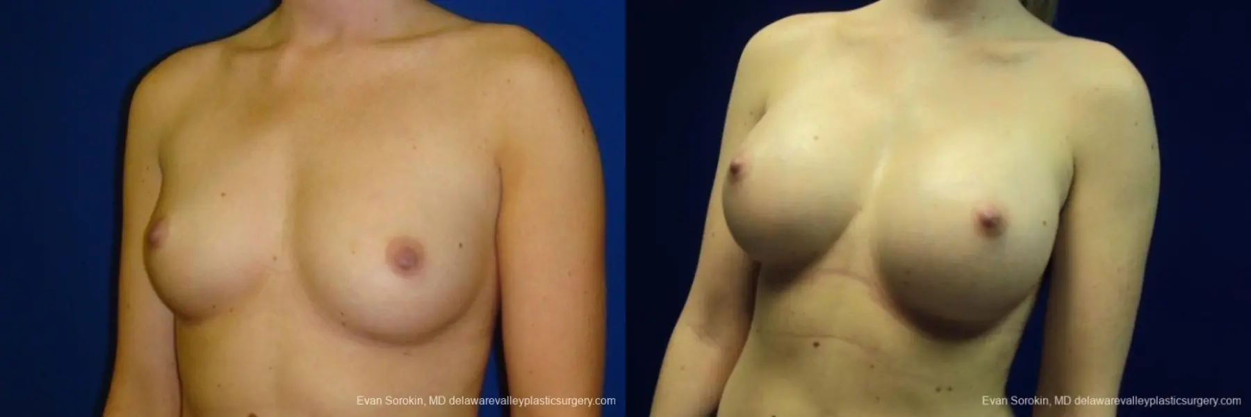 Philadelphia Breast Augmentation 8670 - Before and After 3