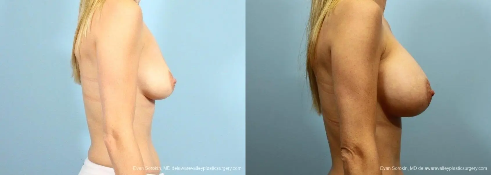 Philadelphia Breast Augmentation 9105 - Before and After 3