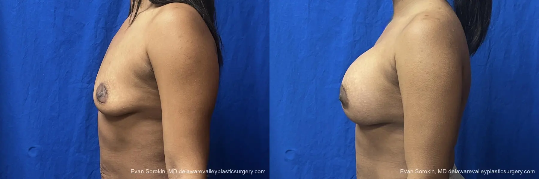 Breast Augmentation: Patient 271 - Before and After 5