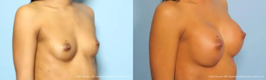 Philadelphia Breast Augmentation 9182 - Before and After 2
