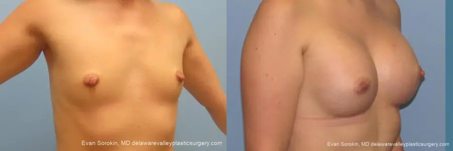 Philadelphia Breast Augmentation 10193 - Before and After 2