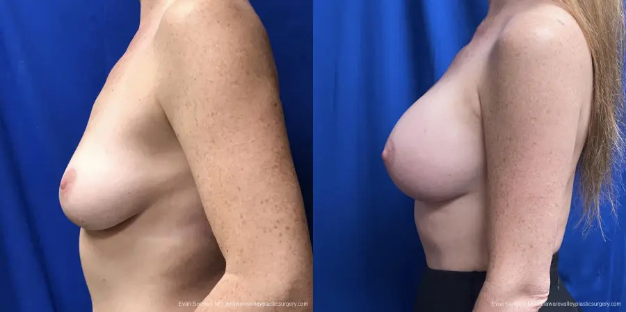 Breast Augmentation: Patient 231 - Before and After 5