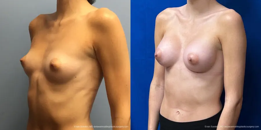 Breast Augmentation: Patient 194 - Before and After 3