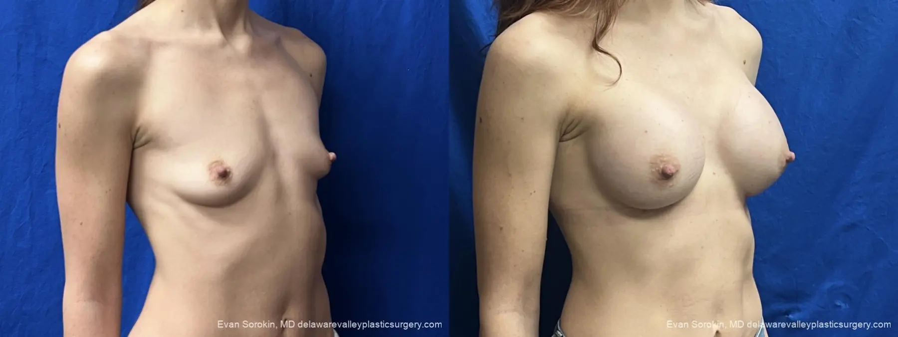Breast Augmentation: Patient 307 - Before and After 2