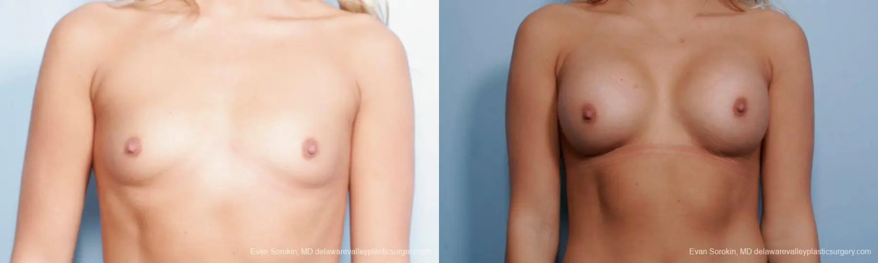 Philadelphia Breast Augmentation 9356 - Before and After 1