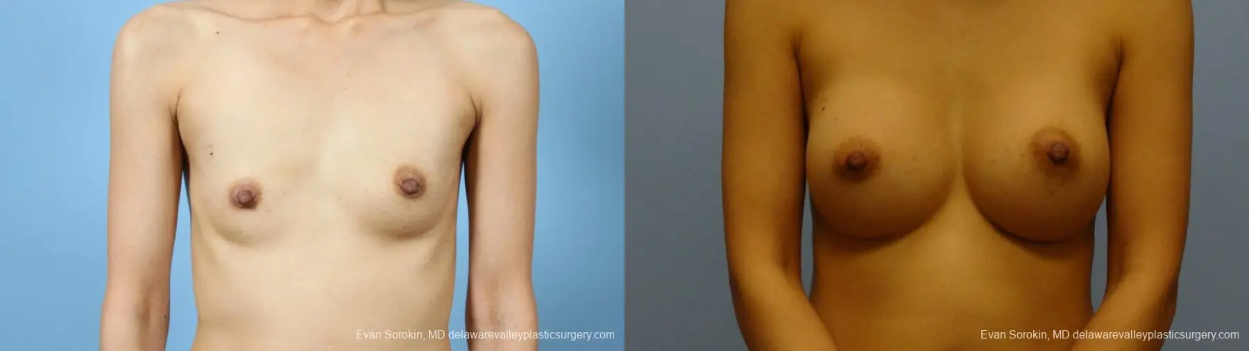 Philadelphia Breast Augmentation 9291 - Before and After 1