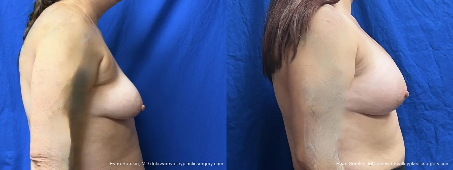 Breast Augmentation: Patient 314 - Before and After 3