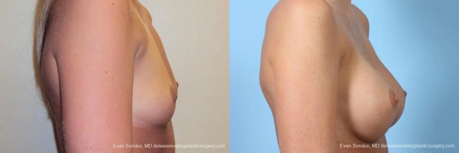 Philadelphia Breast Augmentation 8772 - Before and After 4