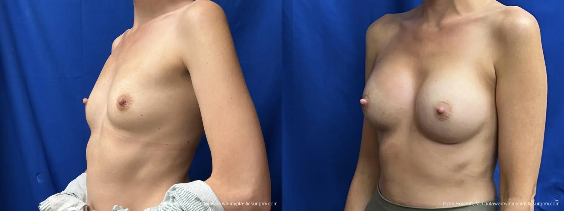 Breast Augmentation: Patient 243 - Before and After 4