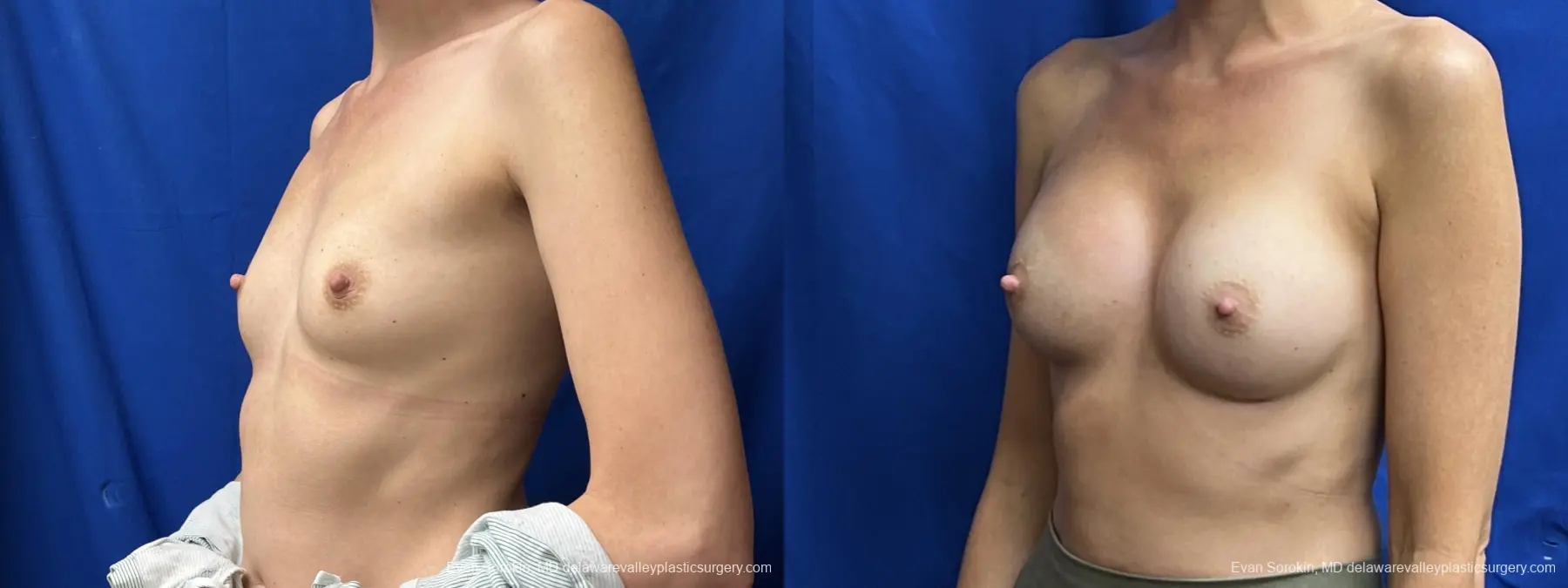 Breast Augmentation: Patient 211 - Before and After 4