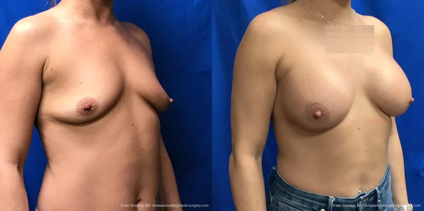 Breast Augmentation: Patient 228 - Before and After 2