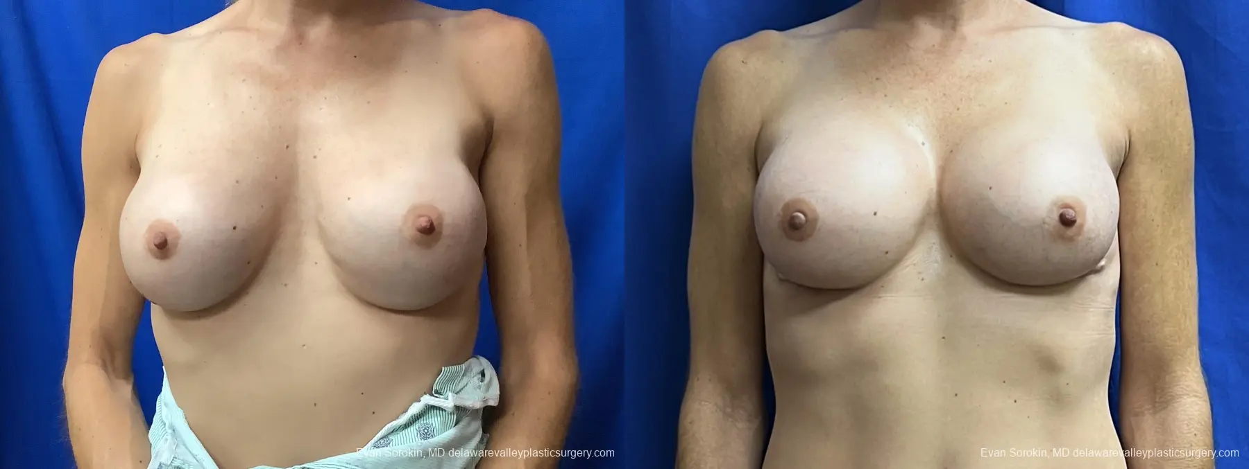Breast Augmentation Revision: Patient 34 - Before and After 1