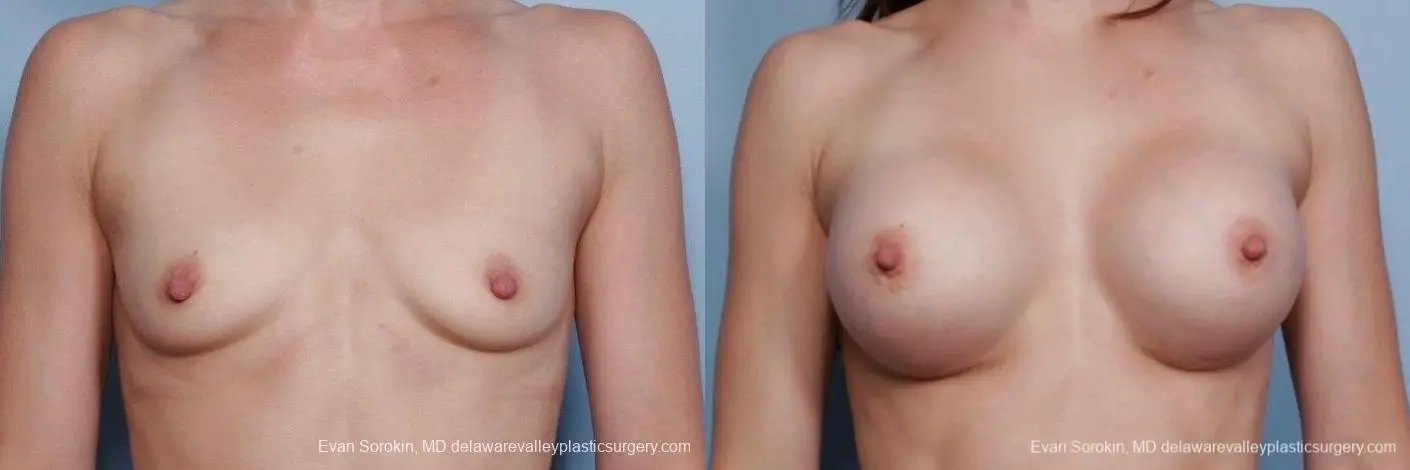 Philadelphia Breast Augmentation 8767 - Before and After 1