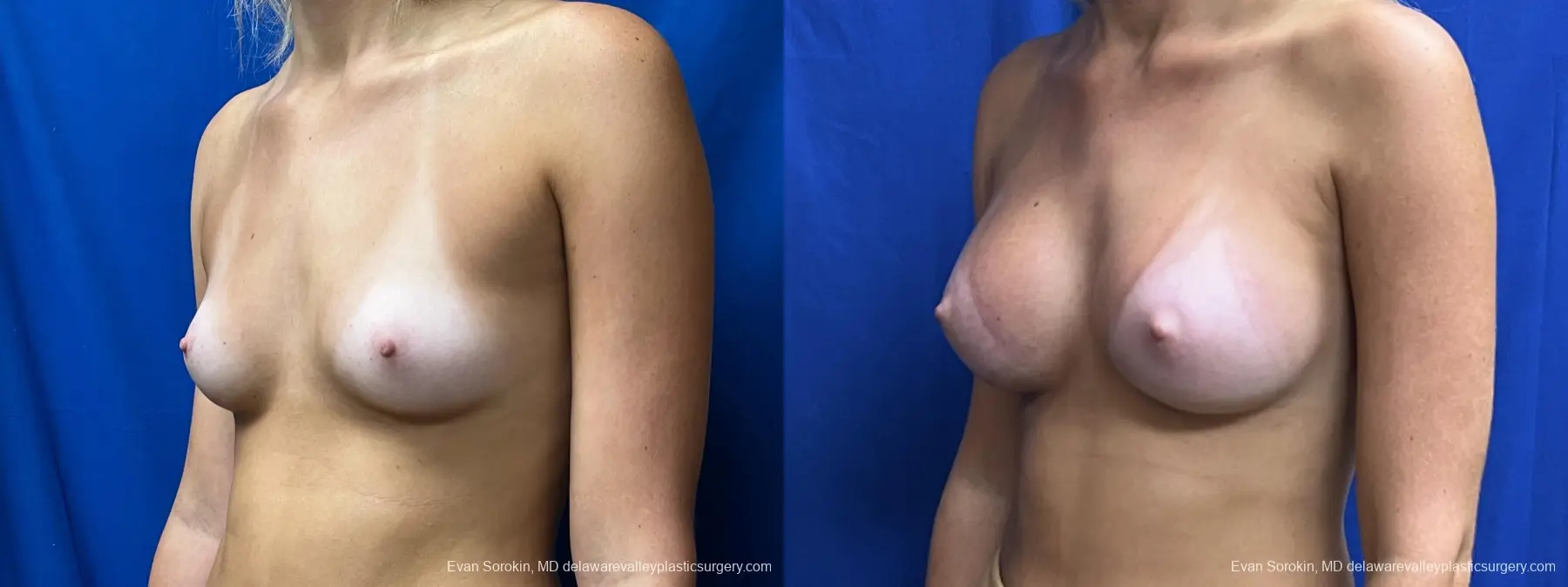 Breast Augmentation: Patient 254 - Before and After 4