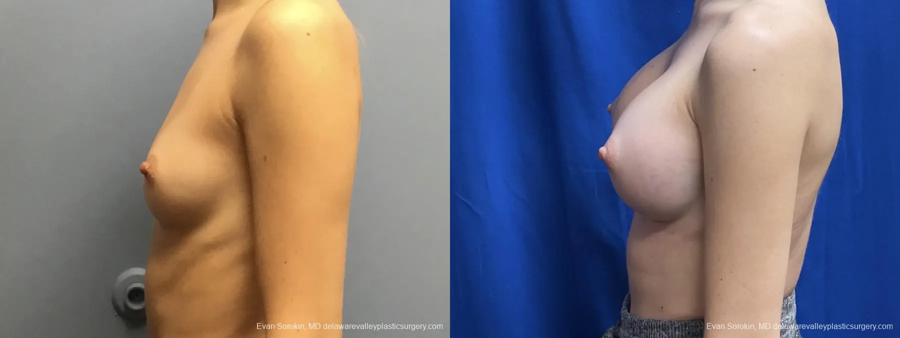 Breast Augmentation: Patient 201 - Before and After 5