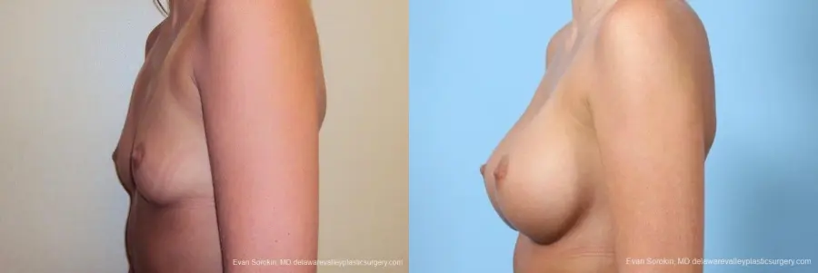 Philadelphia Breast Augmentation 8772 - Before and After 5