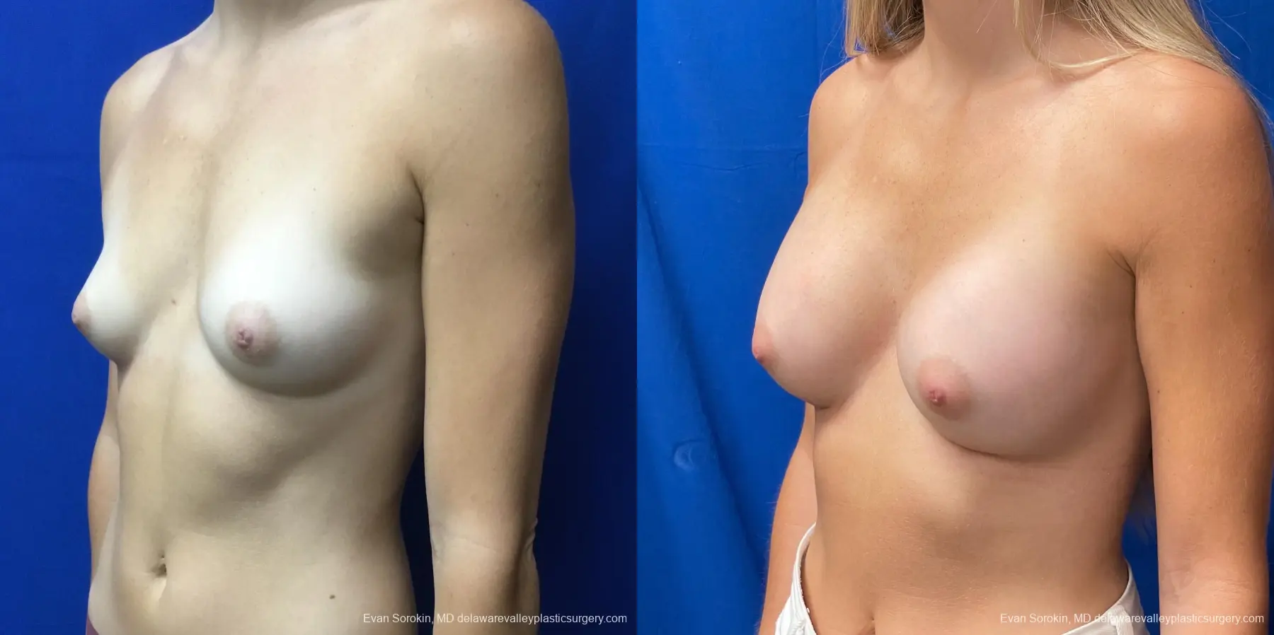 Breast Augmentation: Patient 197 - Before and After 4