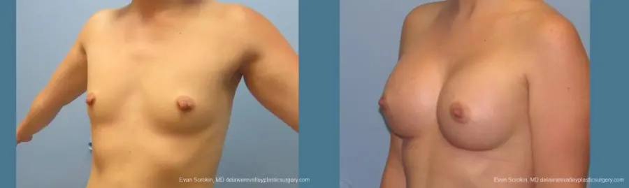 Philadelphia Breast Augmentation 10193 - Before and After 4