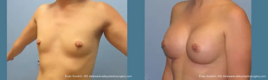 Philadelphia Breast Augmentation 10193 - Before and After 4