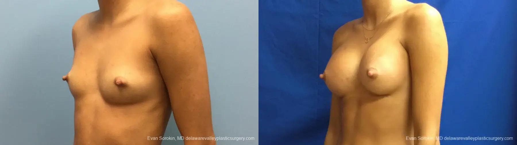 Philadelphia Breast Augmentation 13176 - Before and After 4