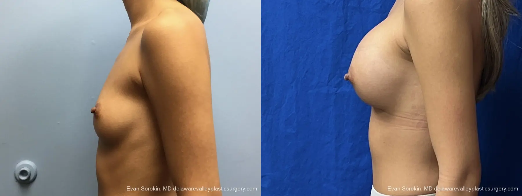 Breast Augmentation: Patient 327 - Before and After 5