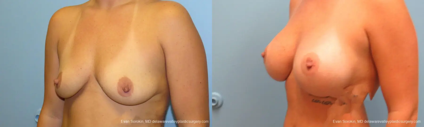 Philadelphia Breast Augmentation 9388 - Before and After 4