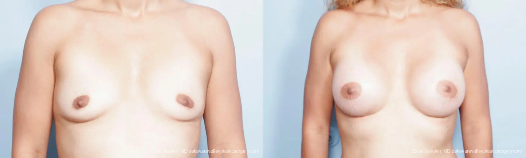 Philadelphia Breast Augmentation 9347 - Before and After 1