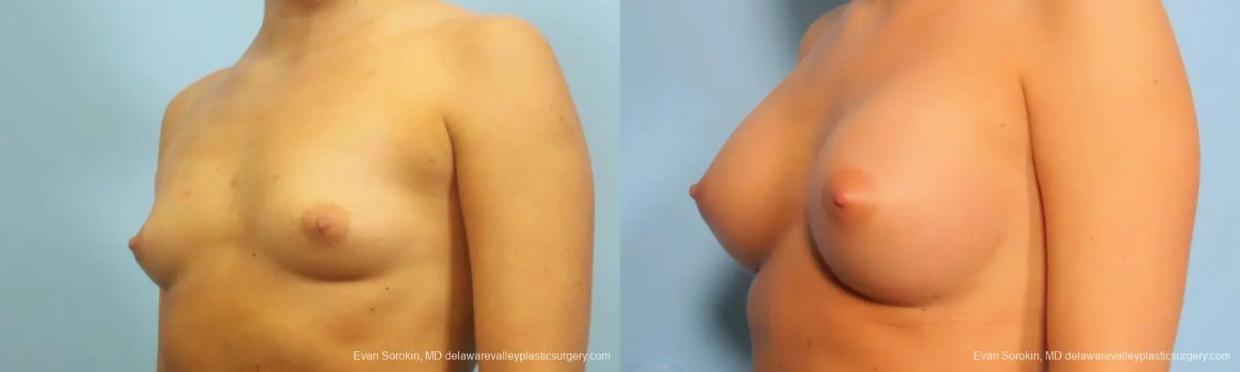 Philadelphia Breast Augmentation 9183 - Before and After 4