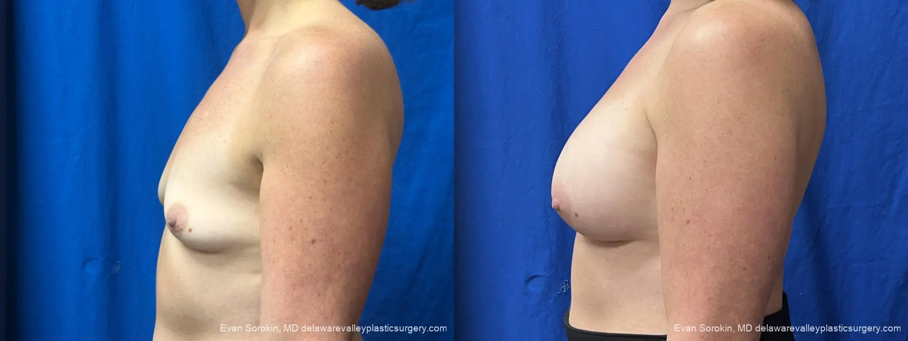 Breast Augmentation: Patient 337 - Before and After 5