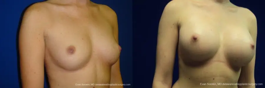 Philadelphia Breast Augmentation 8670 - Before and After 2