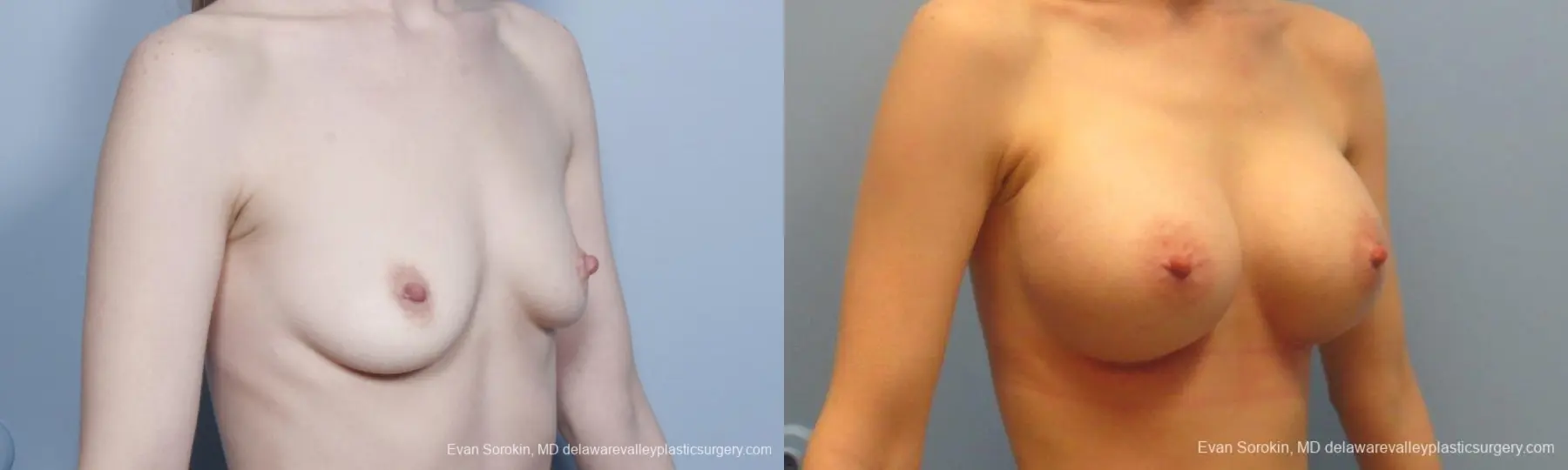 Philadelphia Breast Augmentation 8781 - Before and After 2