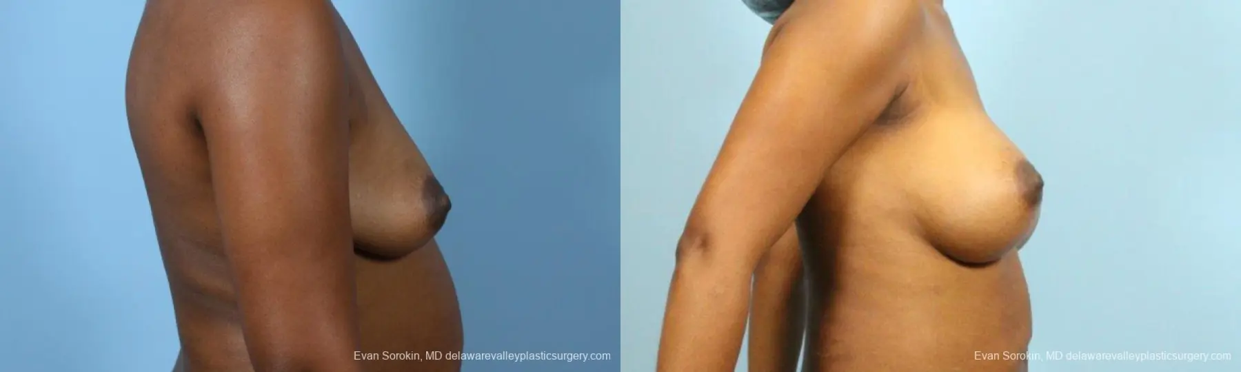 Philadelphia Breast Augmentation 9173 - Before and After 3
