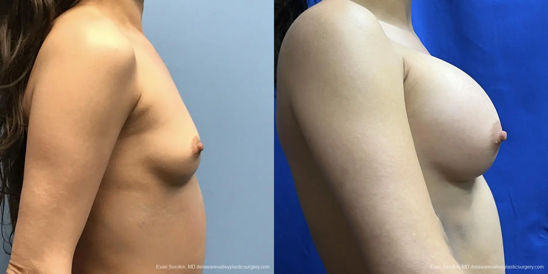 Breast Augmentation: Patient 229 - Before and After 3