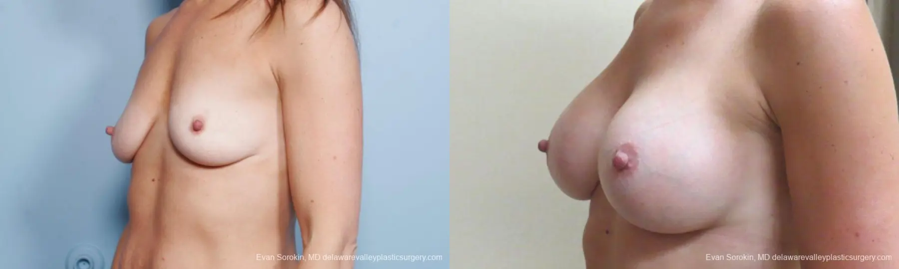 Philadelphia Breast Augmentation 9174 - Before and After 4