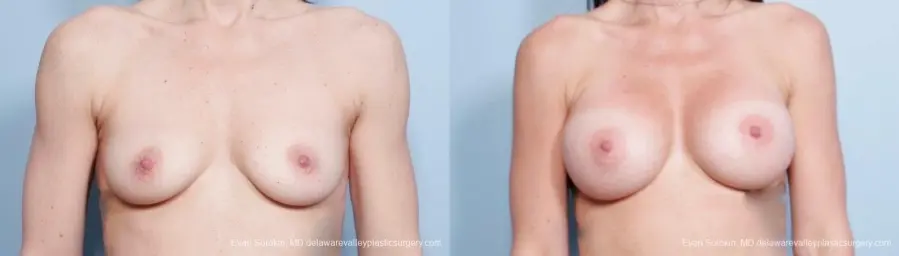 Philadelphia Breast Augmentation 8783 - Before and After 1