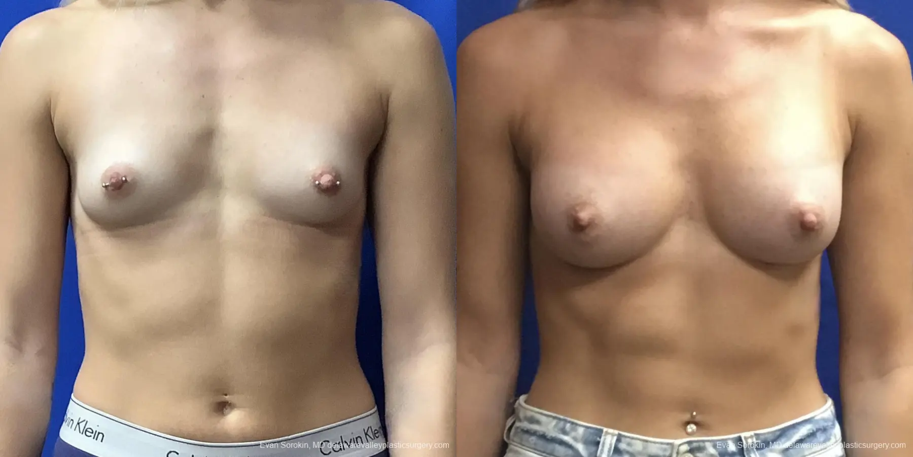 Breast Augmentation: Patient 165 - Before and After 1