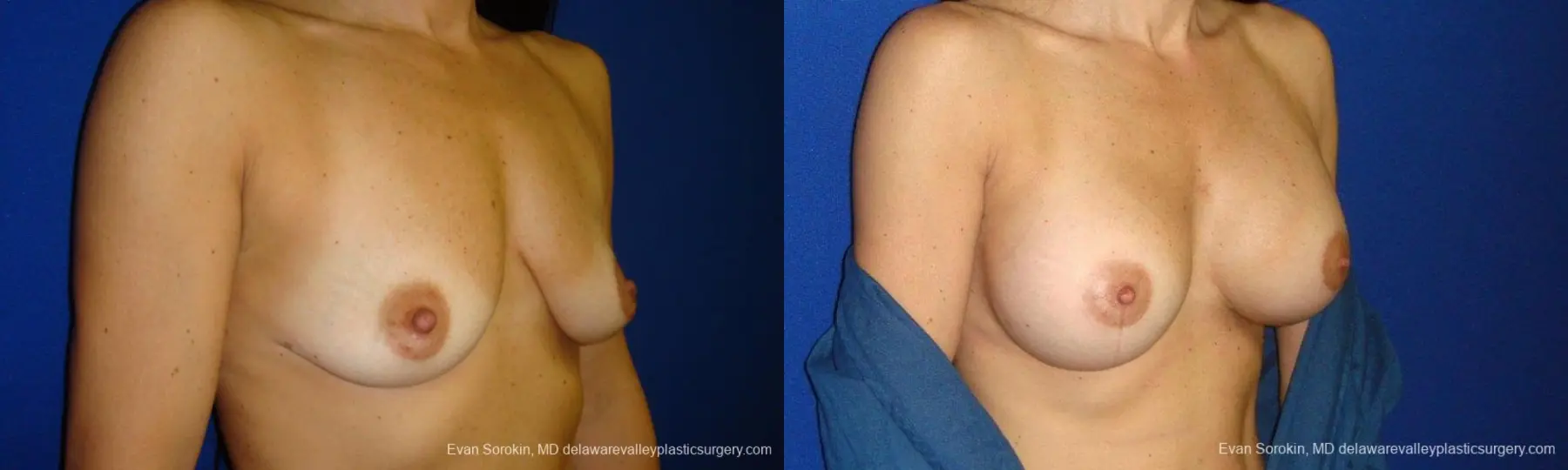 Philadelphia Breast Augmentation 9413 - Before and After 2