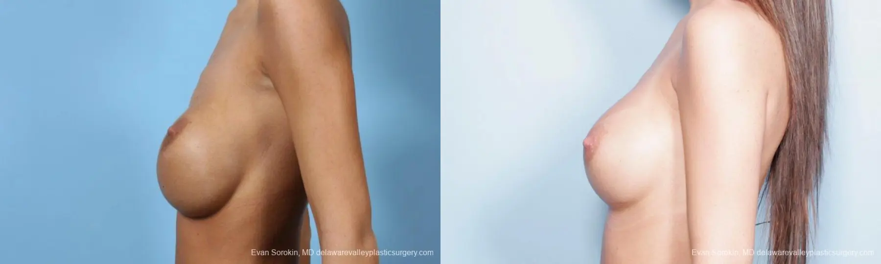 Philadelphia Breast Augmentation 9445 - Before and After 3