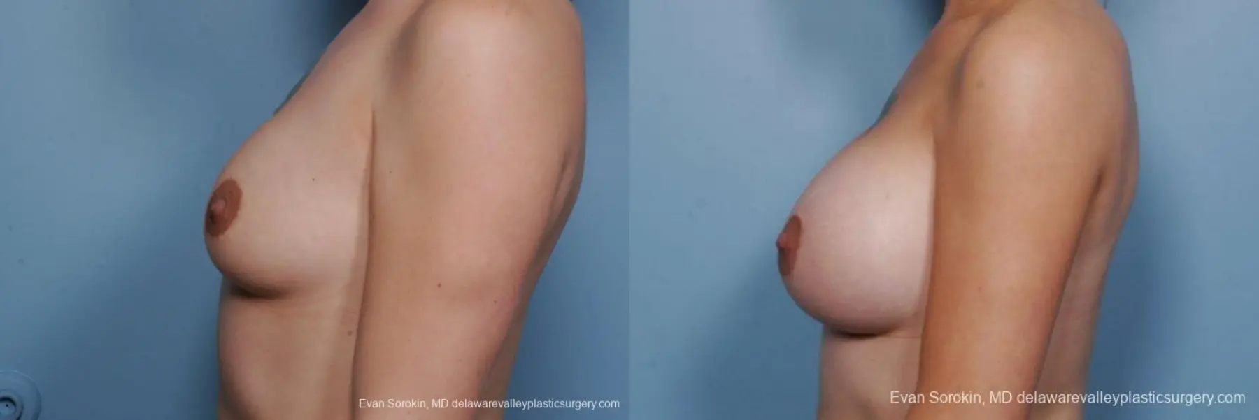 Philadelphia Breast Augmentation 9385 - Before and After 5