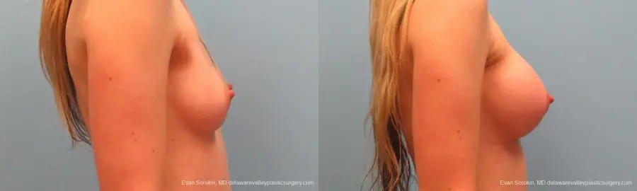 Philadelphia Breast Augmentation 9381 - Before and After 3
