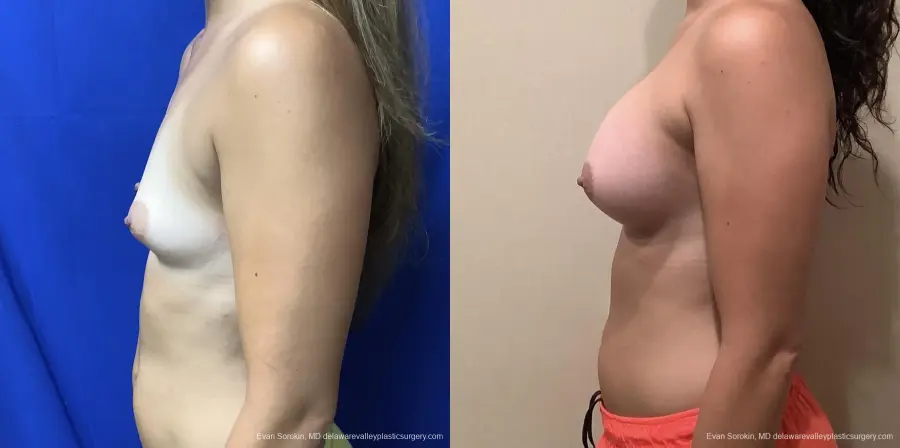 Breast Augmentation: Patient 185 - Before and After 5