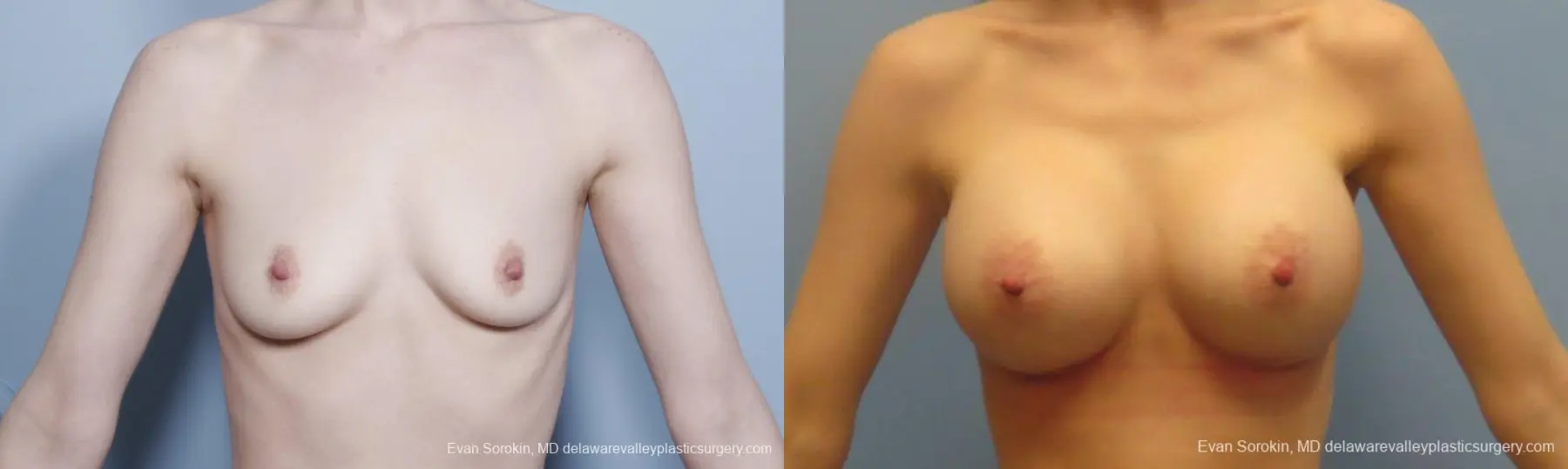 Philadelphia Breast Augmentation 8781 - Before and After 1